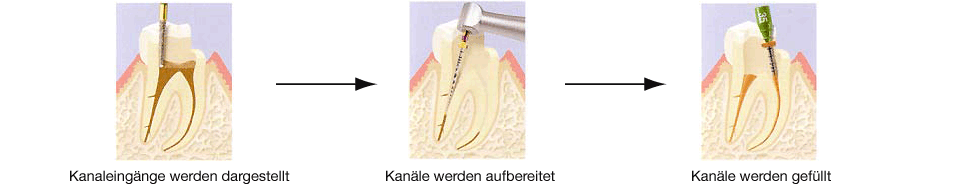 Endodontie Schema